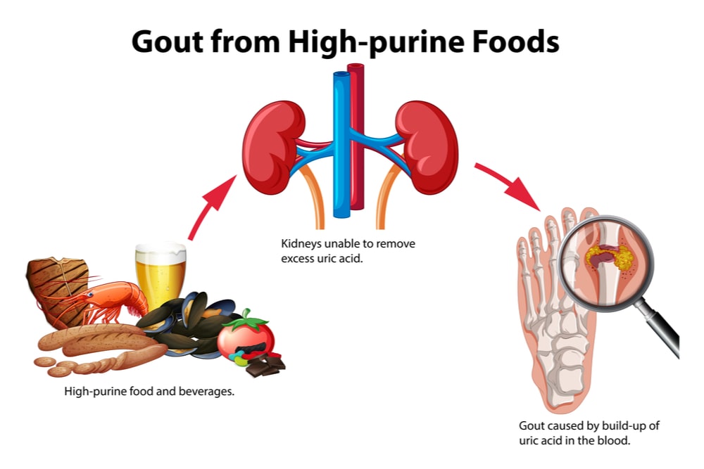 Gout from high purine foods